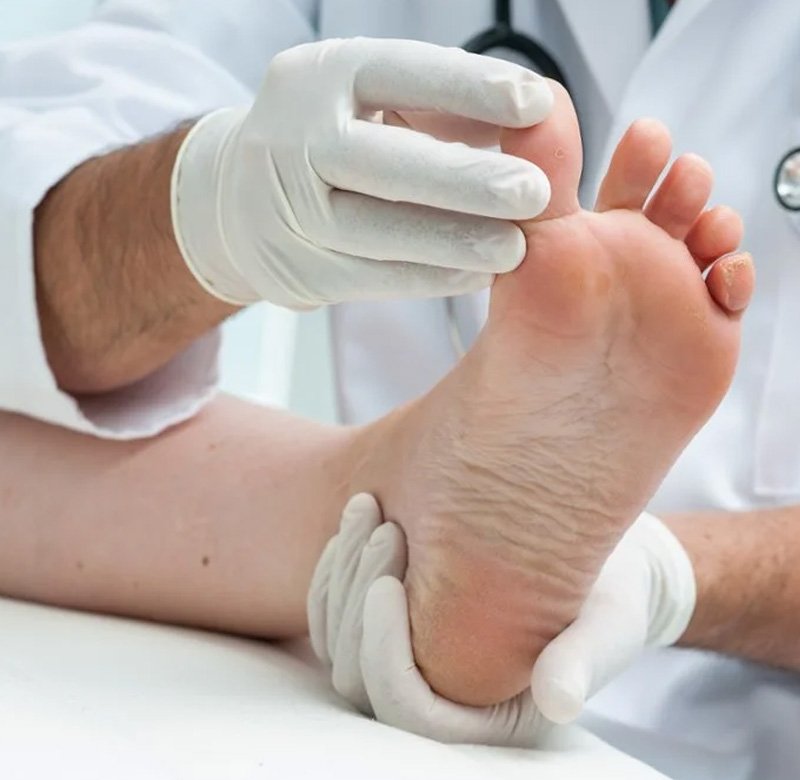 Diabetic Ulcer