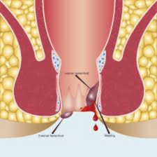 Piles & Fistula