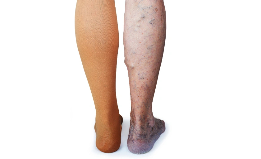 Varicose Vein